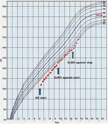 Two Novel Mutations of ANKRD11 Gene and Wide Clinical Spectrum in KBG Syndrome: Case Reports and Literature Review